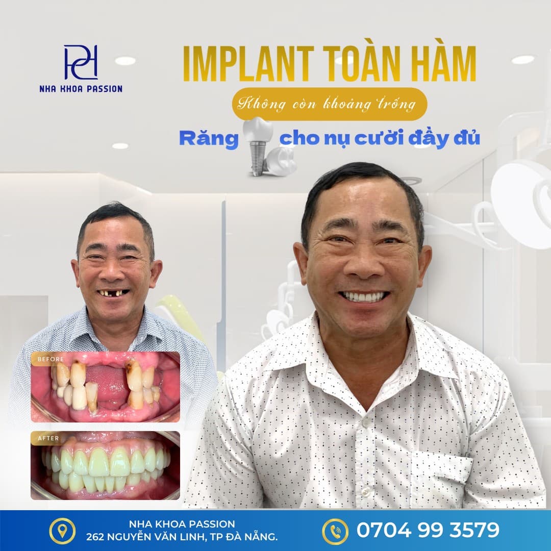 Case Implant toàn hàm