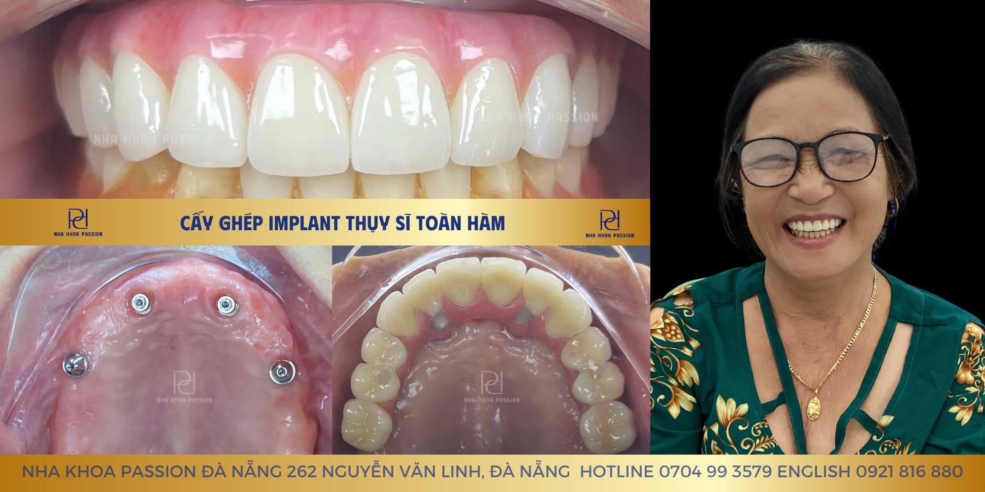 Dental Implant Collage