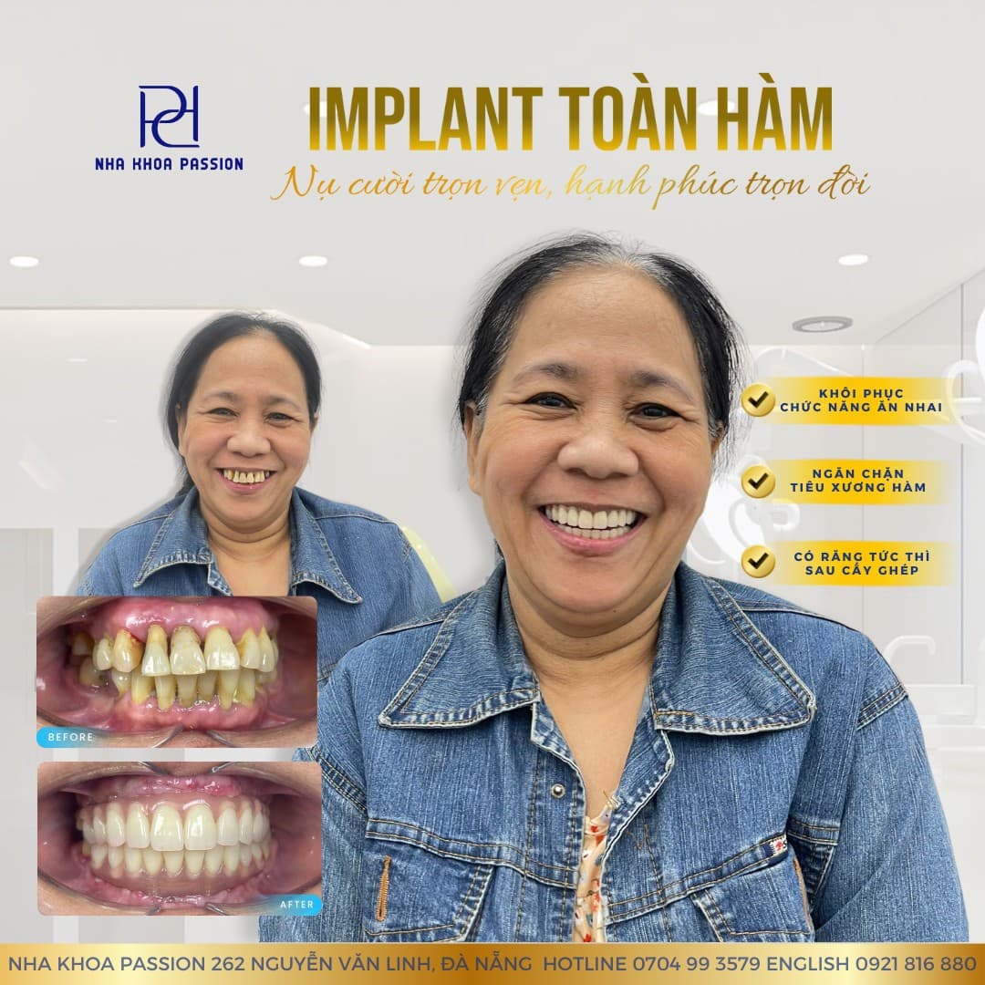 Implant vs Bridge Comparison