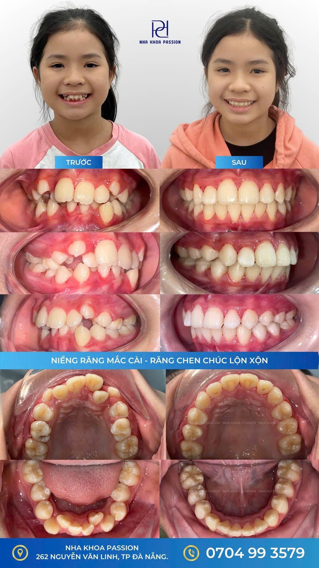 Mắc cài & khay trong suốt